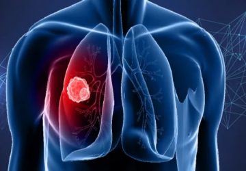 The most effective method to Perceive the Early Side effects of Cellular breakdown in the lungs